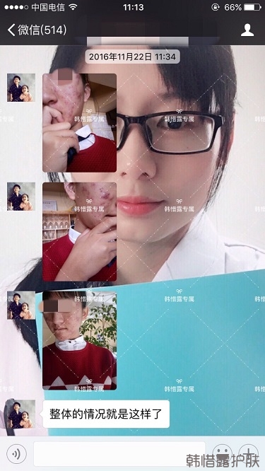 臉上長(zhǎng)痘痘怎么去掉？徹底告別痘痘，自卑到自信的蛻變！