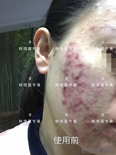 膿包痘痘好了，從慘不忍睹到變美變漂亮