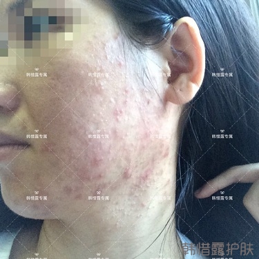 激素臉滿臉粉刺痘痘到光滑健康肌膚的蛻變