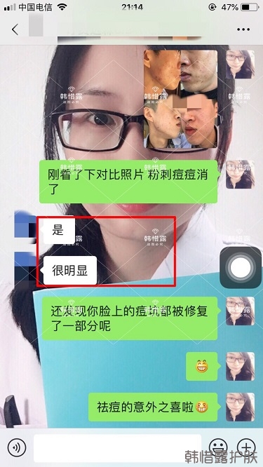 敏感肌粉刺痘痘全部消下去了，痘坑也修復平整了一部分