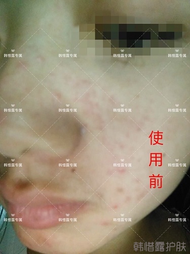 額頭長(zhǎng)痘臉頰長(zhǎng)痘痘粉刺，這樣調(diào)理幫你恢復(fù)嫩白肌膚！