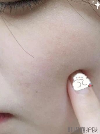 反復長痘這么多年，你需要找準痘因？