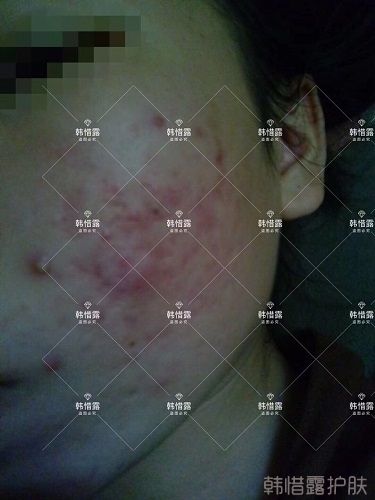 祛痘后判若兩人，膿包痘消了變小仙女