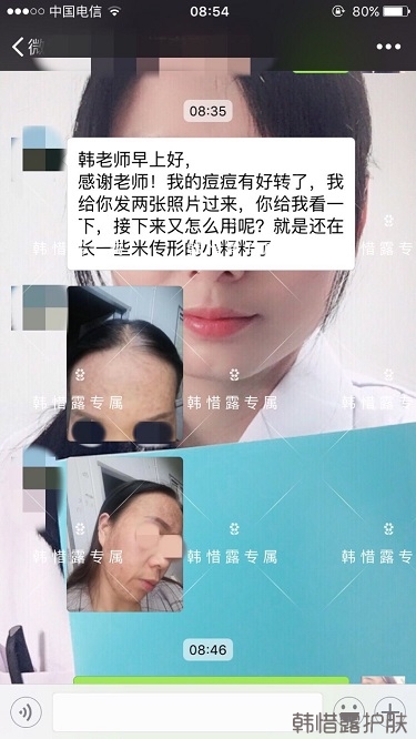 多年的粉刺痘痘，沒想到使用一周后粉刺消了這么多！