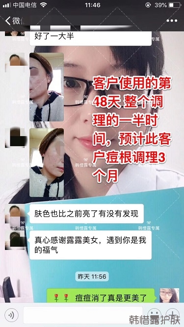 臉上一直長痘痘膿包怎么解決？痘痘開始消了，更美麗！