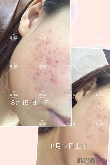 祛痘，痘痘發(fā)炎痘印就選它！