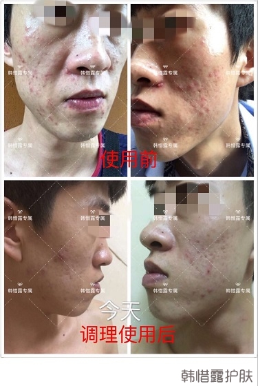 長痘痘找韓惜露，祛痘效果反饋