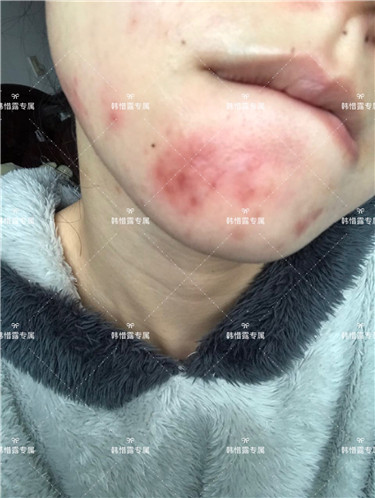 【視頻】臉上長(zhǎng)粉刺怎樣去掉？醫(yī)院都沒搞定韓惜露幫我搞定了，超級(jí)開心！