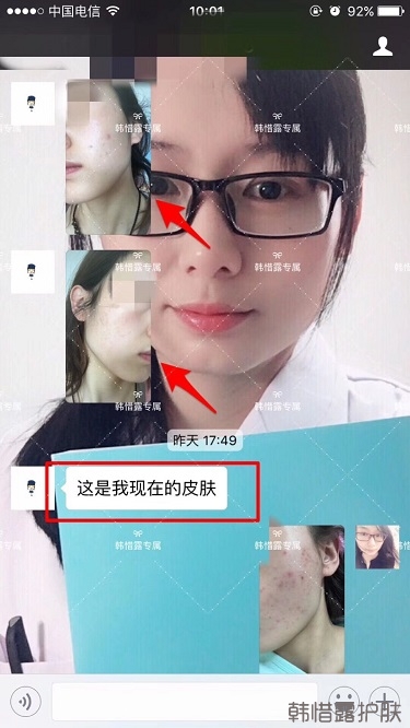 痘痘好了皮膚美麗，不想再記起曾經(jīng)滿臉痘痘的自己！