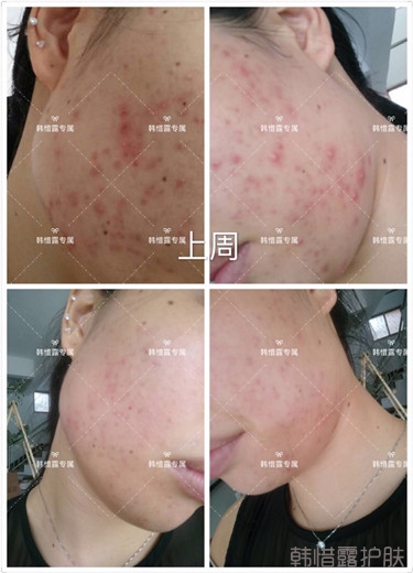 痘痘好多了，認真聽話按照要求使用，每個人都可以變很美！