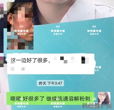 臉上長閉口粉刺怎么去除,粉刺消下去了，皮膚變好了