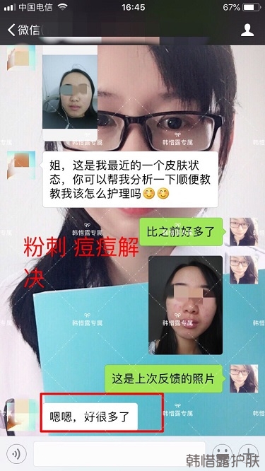 額頭長(zhǎng)痘臉頰長(zhǎng)痘痘粉刺，這樣調(diào)理幫你恢復(fù)嫩白肌膚！