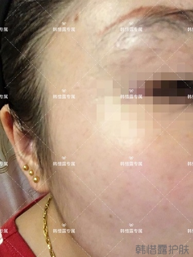 下巴長痘怎么辦？看這里徹底去掉痘痘，不再長痘了！