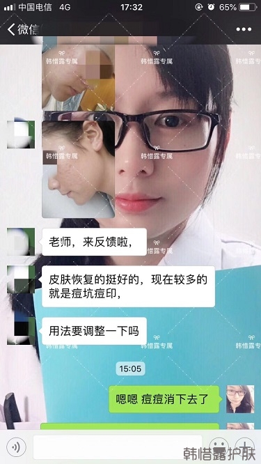 好好使用，膿包痘痘,小粉刺全消了,重點修復(fù)痘印痘坑印了