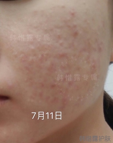 去粉刺效果，單用粉刺膏與祛痘霜也能快快溶解粉刺！