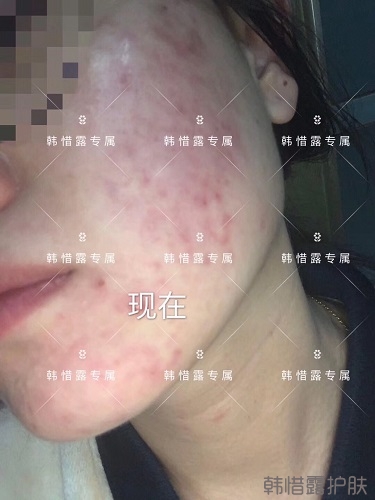 膿包痘痘好了，從慘不忍睹到變美變漂亮