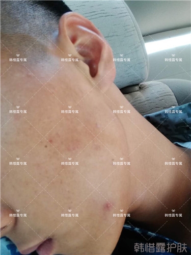 粉刺消了，皮膚光滑了，變帥氣不少呦！