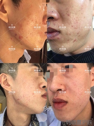 敏感肌粉刺痘痘全部消下去了，痘坑也修復平整了一部分