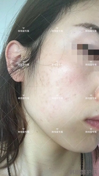 痘痘好了皮膚美麗，不想再記起曾經(jīng)滿臉痘痘的自己！