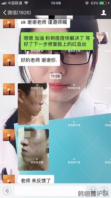 長痘痘找韓惜露，祛痘效果反饋