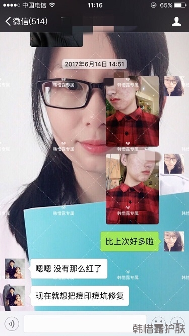 臉上長(zhǎng)痘痘怎么去掉？徹底告別痘痘，自卑到自信的蛻變！