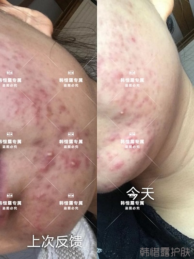 臉上長痘如何消除，下巴長痘案例反饋，膿包痘痘好多了
