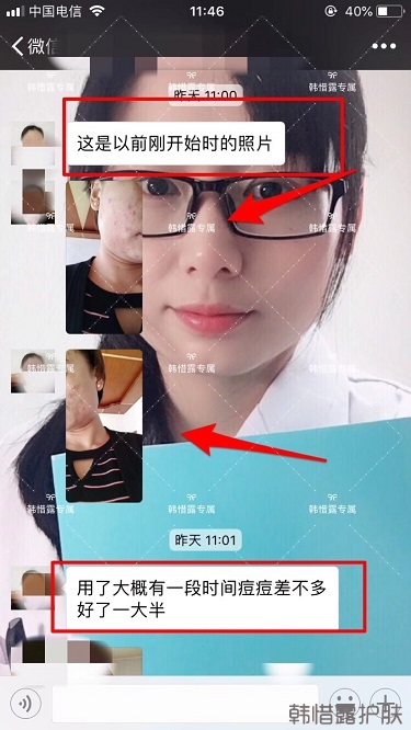 臉上一直長痘痘膿包怎么解決？痘痘開始消了，更美麗！