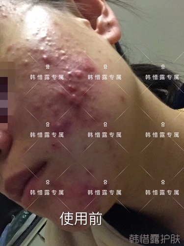 膿包痘痘好了，從慘不忍睹到變美變漂亮