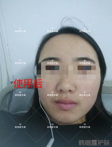 額頭長(zhǎng)痘臉頰長(zhǎng)痘痘粉刺，這樣調(diào)理幫你恢復(fù)嫩白肌膚！