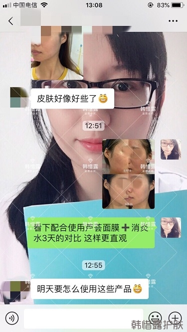 3天痘痘好多了，開心