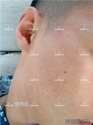 粉刺消了，皮膚光滑了，變帥氣不少呦！