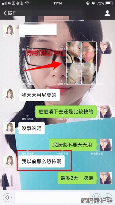 膿包痘祛痘效果，擁有干凈的臉不等待！