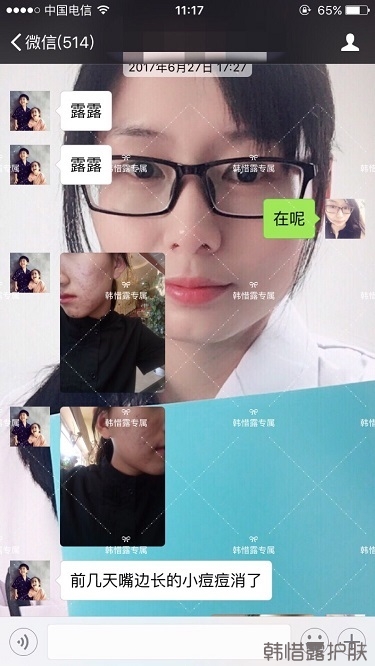 臉上長(zhǎng)痘痘怎么去掉？徹底告別痘痘，自卑到自信的蛻變！