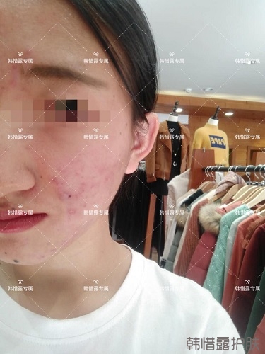 臉上長(zhǎng)痘痘怎么去掉？徹底告別痘痘，自卑到自信的蛻變！