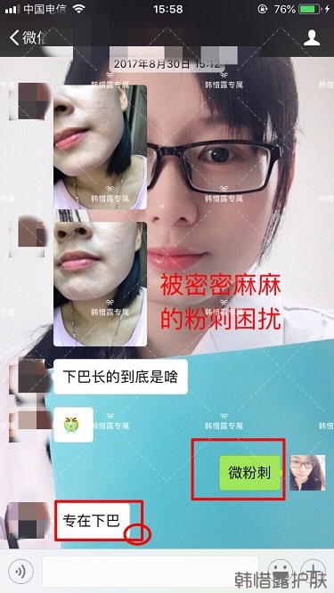 粉刺密密麻麻，試過很多方法無果后找韓惜露老師輕松去掉粉刺！