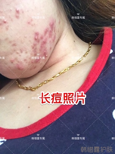 下巴長痘怎么辦？看這里徹底去掉痘痘，不再長痘了！