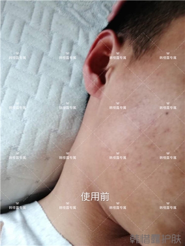 粉刺消了，皮膚光滑了，變帥氣不少呦！