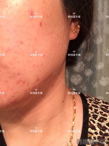 下巴長痘怎么辦？看這里徹底去掉痘痘，不再長痘了！