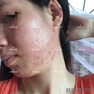 激素臉滿臉粉刺痘痘到光滑健康肌膚的蛻變