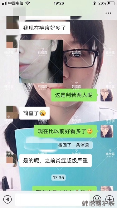 祛痘后判若兩人，膿包痘消了變小仙女