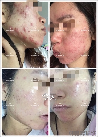 膿包痘祛痘效果，擁有干凈的臉不等待！