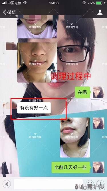 粉刺密密麻麻，試過很多方法無果后找韓惜露老師輕松去掉粉刺！