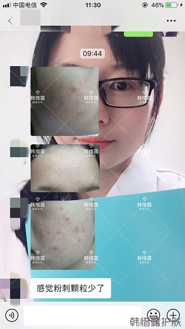 去粉刺效果，單用粉刺膏與祛痘霜也能快快溶解粉刺！