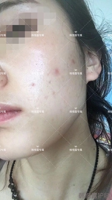 痘痘好了皮膚美麗，不想再記起曾經(jīng)滿臉痘痘的自己！