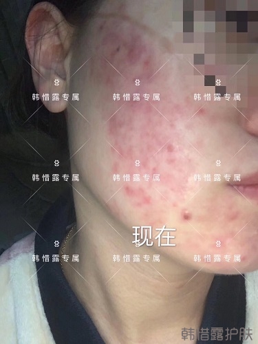 膿包痘痘好了，從慘不忍睹到變美變漂亮