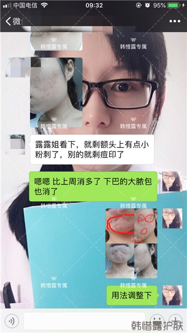 粉刺只剩一點點了，敏感肌粉刺修復(fù)，更美麗！