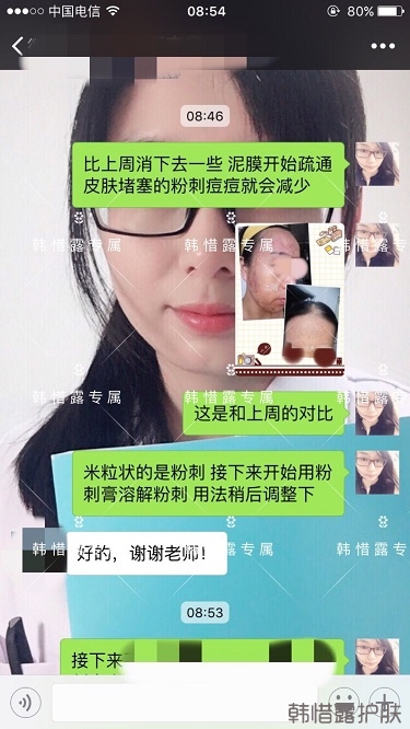 多年的粉刺痘痘，沒想到使用一周后粉刺消了這么多！