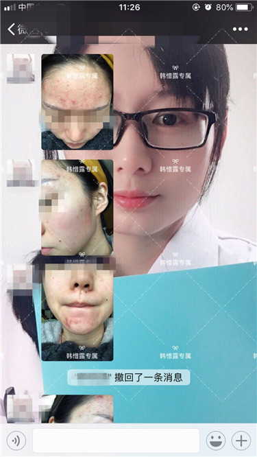 【視頻】臉上長(zhǎng)粉刺怎樣去掉？醫(yī)院都沒搞定韓惜露幫我搞定了，超級(jí)開心！