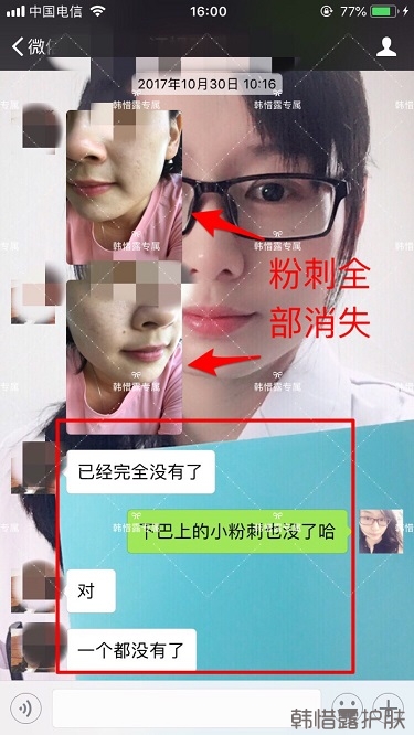 粉刺密密麻麻，試過很多方法無果后找韓惜露老師輕松去掉粉刺！
