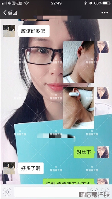 粉刺消了，皮膚光滑了，變帥氣不少呦！